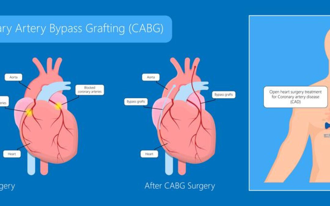 Advantages of Minimally Invasive Bypass Surgery over Traditional Bypass